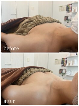 リノ 行橋(lino)/◇バストアップ症例◇30代