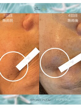 ポノ(Pono)/4回目のbefore/after☆