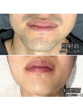 レブロン(LeBron)/髭脱毛ビフォーアフター