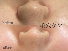 Olu【オル】肌質改善サロン. ハーブピーリング/クリスティーナ/クリスティーナトリートメント