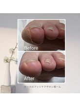 楽ーん/巻き爪矯正BSスパンゲ施術事例♪