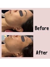 メロウ(Mello)/リフトアップ◇Before→after