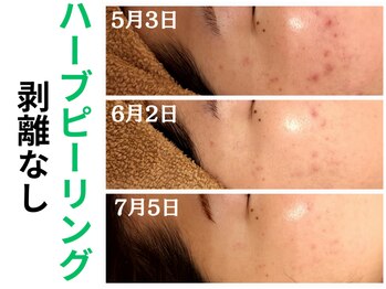 エリン(ERIN)/ハーブピーリング