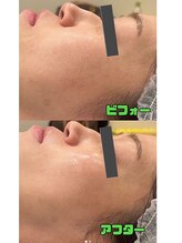 アモ(amo)/ハーブピーリング1回施術後
