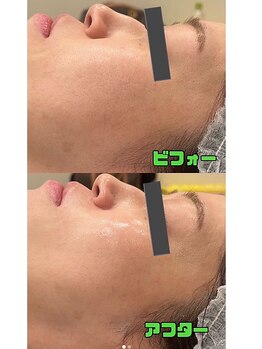 アモ(amo)/ハーブピーリング1回施術後