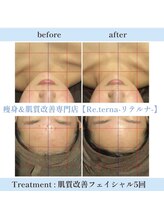 リテルナ(Re.terna)/肌質改善フェイシャル