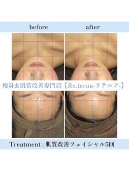リテルナ(Re.terna)/肌質改善フェイシャル
