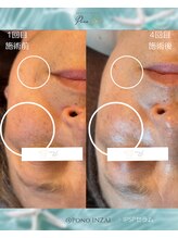 ポノ(Pono)/4回目のbefore/after