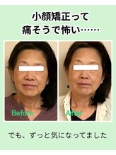 ベルソー(Berceau)/