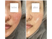 1回目→6回目　しっかりとお肌の土台を作り健康的なお肌へ◎