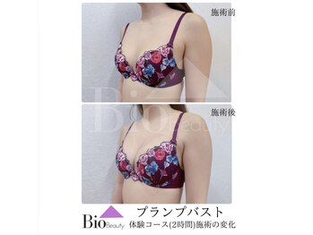 バイオビューティー 神戸本店(Bio Beauty)/プランプバスト　体験コース症例