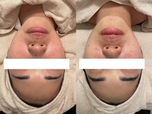 ハイファイブ(Hi-Five)/ポテンツァ/（施術3回)