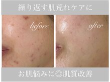 アリスビューティー(AliceBeauty)/繰り返す肌荒れケアに