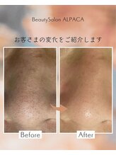 アルパカ(ALPACA)/毛穴のお悩み