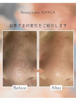 アルパカ(ALPACA)/毛穴のお悩み