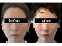 スリーメイ(3mey)/継続すれば糸リフト超え