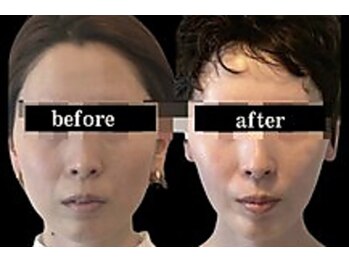 スリーメイ(3mey)/継続すれば糸リフト超え