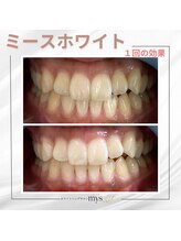 ミースホワイトニング(mys whitening)/ビフォーアフター【歯科提携】
