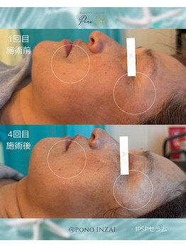 ポノ(Pono)/4回目のbefore/after☆