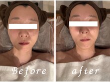 一度で効果絶大！ほぐしてキュッ！筋肉を整えて顔面短縮★