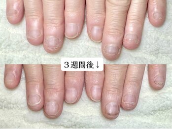 グラシナ なんば店/深爪/自爪育成/フィルイン