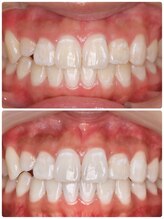 ホノルルホワイトニング 京橋店/12回券 ホワイトニング症例写真