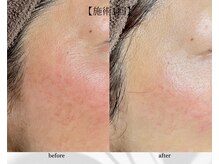 アン ビューティー(ann beauty)/施術1回【症例写真】