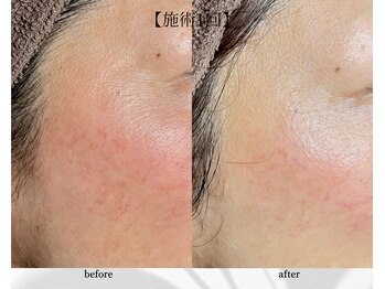 アン ビューティー(ann beauty)/施術1回【症例写真】