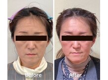 小顔22 ボルティ 赤坂支店(Bolty)/小顔シンメトリー矯正＆全身矯正