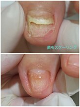 レフス 北参道店(REFUSS)/長年抱えていた爪のトラブル