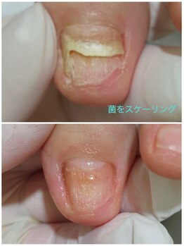 レフス 北参道店(REFUSS)/長年抱えていた爪のトラブル