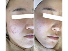 モカ 天王寺店(MOKA)/剥離　ハーブピーリング　毛穴