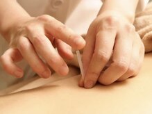 肩こりや腰痛などの痛みを鍼灸で根本からケアいたします◎