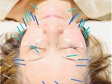 ウツクシ 三軒茶屋(UTUKUSHI)/お悩みに合わせて鍼をうちます