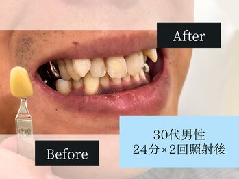 ホワイトニングカフェ アスピア明石店(WhiteningCafe)/◎歯のホワイトニング施術写真◎