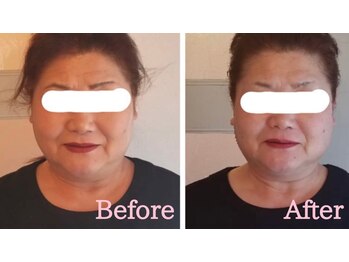 小顔矯正サロン ブルーム/施術1回のビフォーアフター