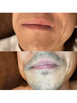 アイビー(IVY)/初回無料と合わせて5回の結果！