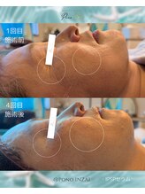 ポノ(Pono)/4回目のbefore/after☆