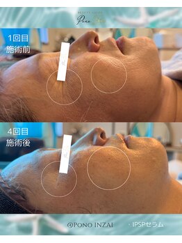 ポノ(Pono)/4回目のbefore/after☆