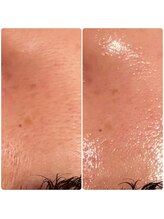 レンリー(Renry)/レモンボトルは、毛穴にも◎