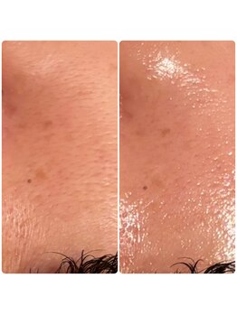 レンリー(Renry)/レモンボトルは、毛穴にも◎