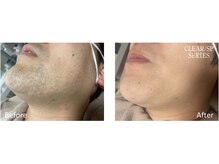 アットイカウ 下北沢(at ikaw)/全顔スッキリ脱毛 Before/After 