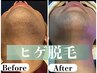 【最短ヒゲ脱毛】人気No.1メンズ☆今だけ平日限定９８０円