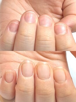 マリーロール 梅田店(Marie Laure)/自爪育成/深爪矯正/ネイルケア