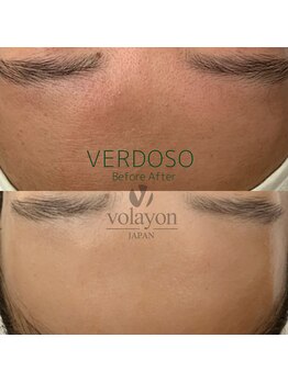 ジュエッテ(jouete)/volayon