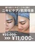 【ニキビケア】セルマンピーリング(120分) 通常22,000→1,1000円
