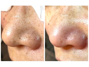 ラロリ(Laloli)/毛穴 改善コース