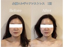 ミベル(MeBell)/小顔コルギ＋クリスティーナ