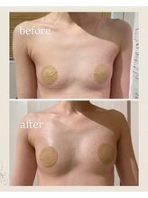 アンフィルミエール 新宿店(infirmiere)/バストアップ