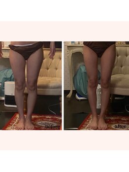 リリー ボヌール(Lily bonheur)/ソニック美脚トリートメント